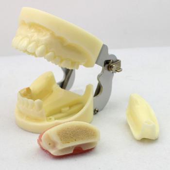 ENOVO Modello esercizio impianto dentale con protesi rimovibile