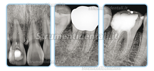 VISIODENT® RSV4 Sensore intraorale per radiografia dentale mappa