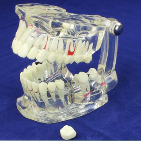 ENOVO Modello malattie dentali demo