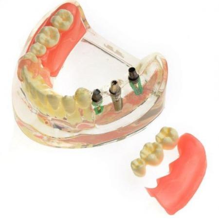 M-6006 Modello odontotecnici Restauro implantare per molari perduti