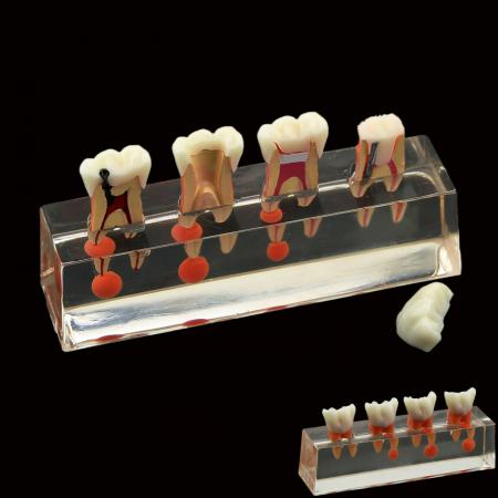 Denti dentari Modello 4-Stage Endodontico Modello 4-Stage Trattamento Endodontico Dimostra Anatomico M4018-01