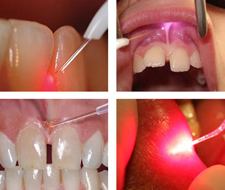Laser a diodo GaAlAs dentale Dimed Berylas Blue 450nm/650nm/980nm 0,5W/4W/10W