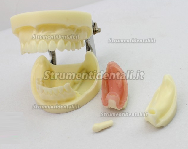 ENOVO Modello esercizio impianto dentale con protesi rimovibile