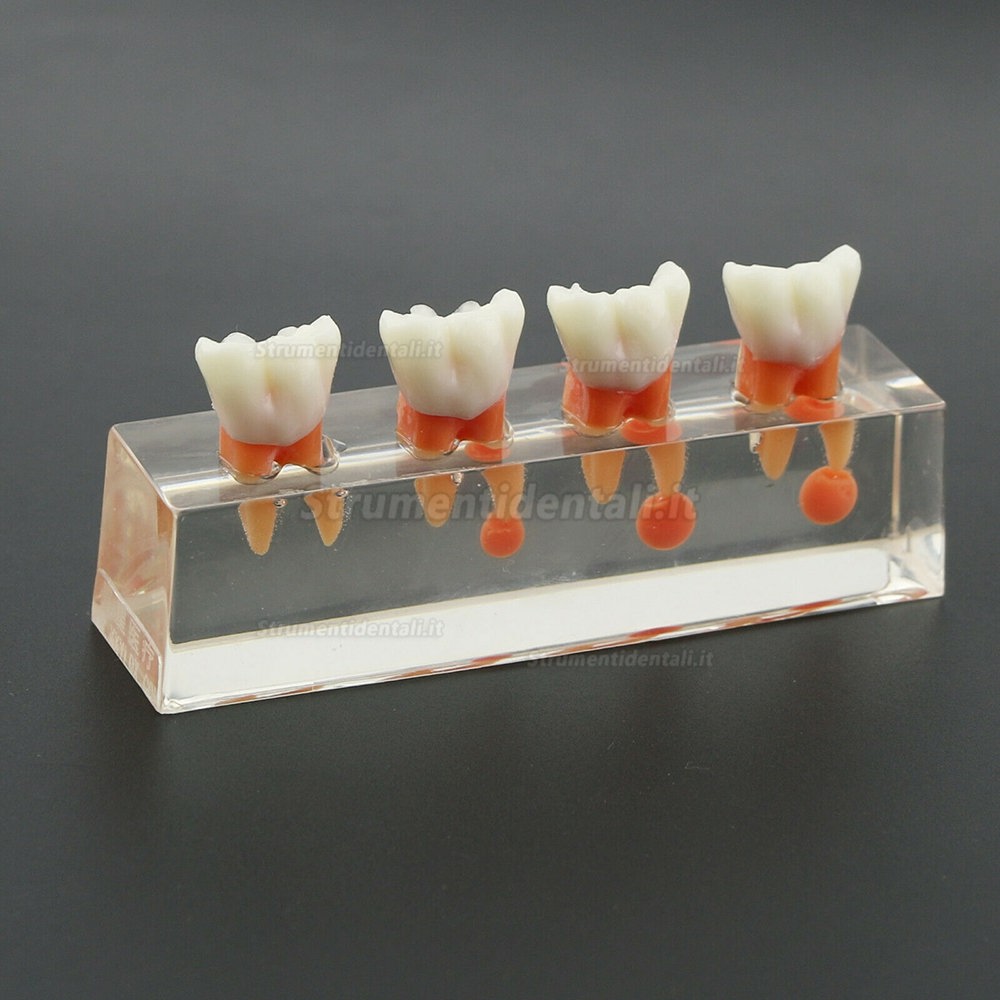 Denti dentari Modello 4-Stage Endodontico Modello 4-Stage Trattamento Endodontico Dimostra Anatomico M4018-01