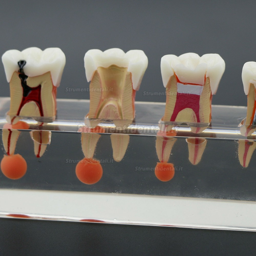 Denti dentari Modello 4-Stage Endodontico Modello 4-Stage Trattamento Endodontico Dimostra Anatomico M4018-01