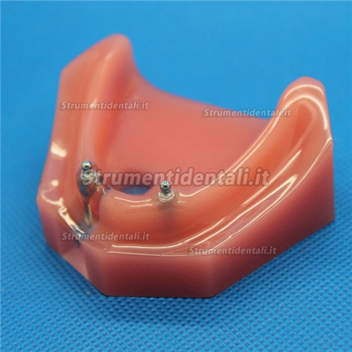 M-6007 Modello odontotecnici per la riparazione impianto dentale