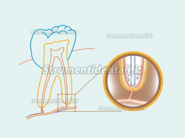 4 Scatola aghi endodontici e parodontali per irrigazione 30G