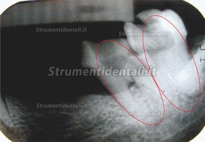 Denjoy® RCTI-DY (I) Instrument da trattamento canalare