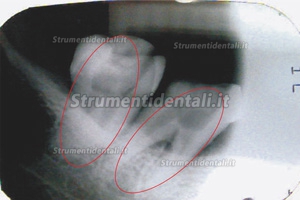 Denjoy® RCTI-DY (I) Instrument da trattamento canalare