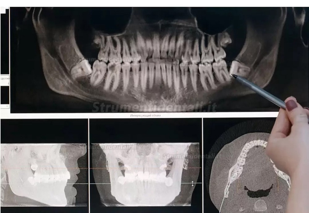 Attrezzature per la chirurgia piezoelettrica odontoiatria Refine MaxSurgery Attrezzature per la chirurgia piezoelettrica odontoiatria Refine MaxSurgery