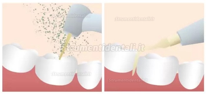 Attrezzature per la chirurgia piezoelettrica odontoiatria Refine MaxSurgery Attrezzature per la chirurgia piezoelettrica odontoiatria Refine MaxSurgery
