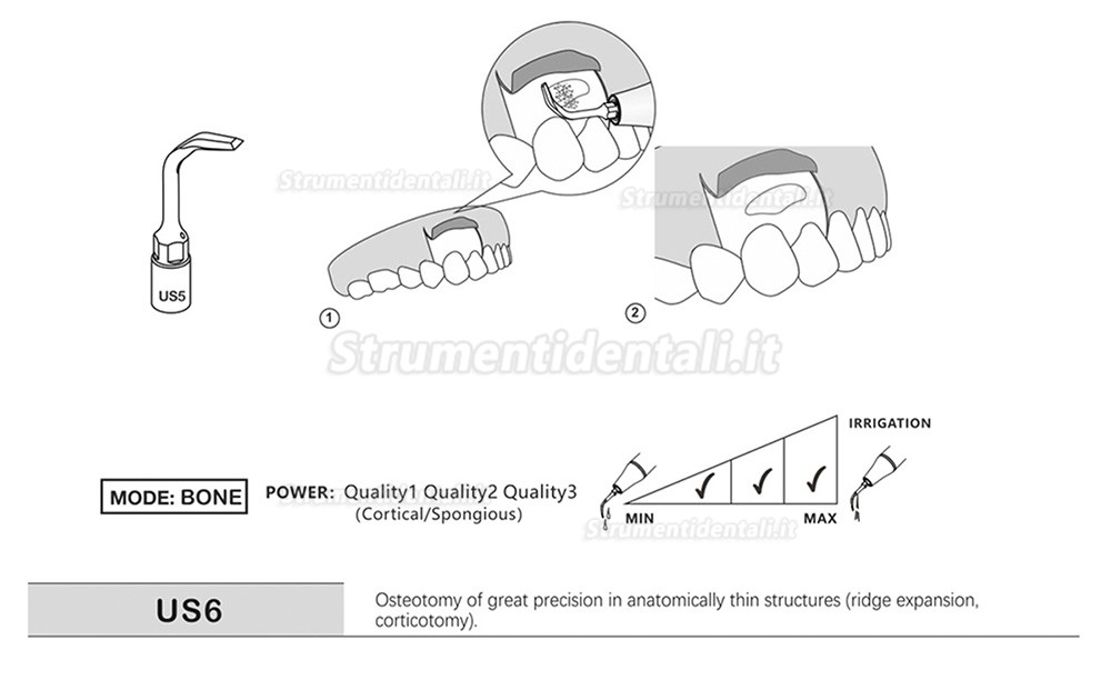 1Pz Inserti Piezomed Per La Chirurgia Ossea US1 US1L US1R US2 US3 US4 US5 US6 US7 US11 US12 Compatible Con Mectron, Silfradent, Dmetec e Woodpecker