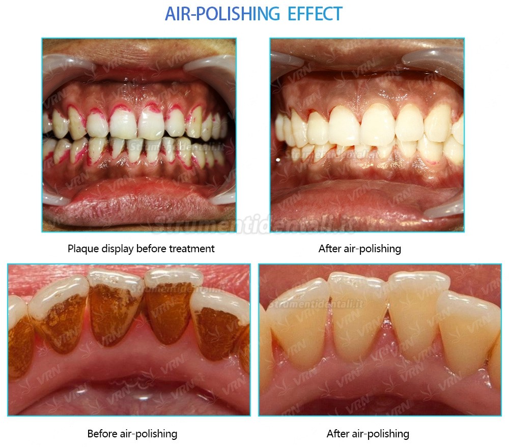 VRN-Q6 Sbiancatore air prophy / lucidatore odontoiatrico + Ablatore ad ultrasuoni