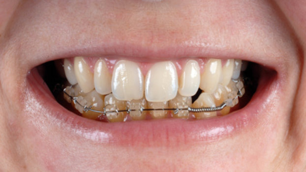 Apparecchio per i denti: a ciascuno il suo - esobd2.com